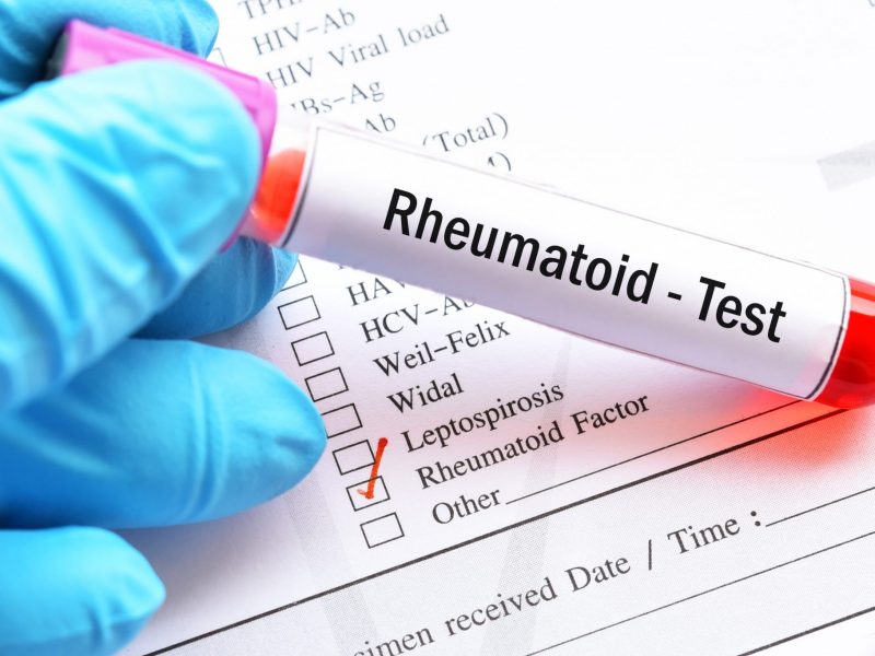 Amostra de sangue para teste de fator reumatóide (RF)