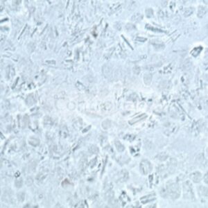 Liquido Sinovial Cristais