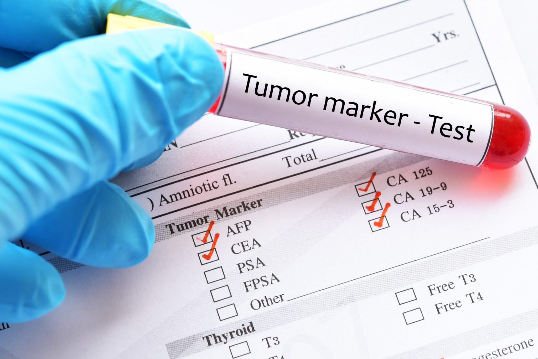 Tumor Markers – Controllab