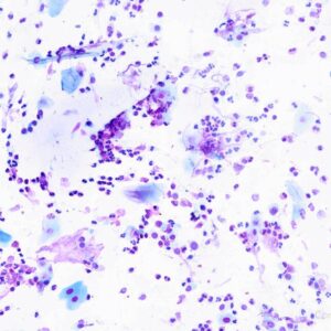 Lâmina - Pesquisa de Eosinófilos - Muco