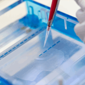 Eletroforese de Proteínas – Líquidos Cavitários