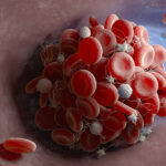 Controllab promove capacitação gratuita sobre anticoagulante lúpico